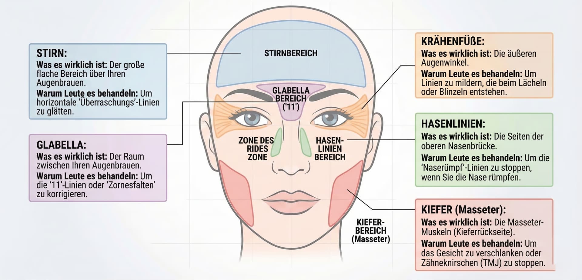 Karte der Botox-Injektionszonen
