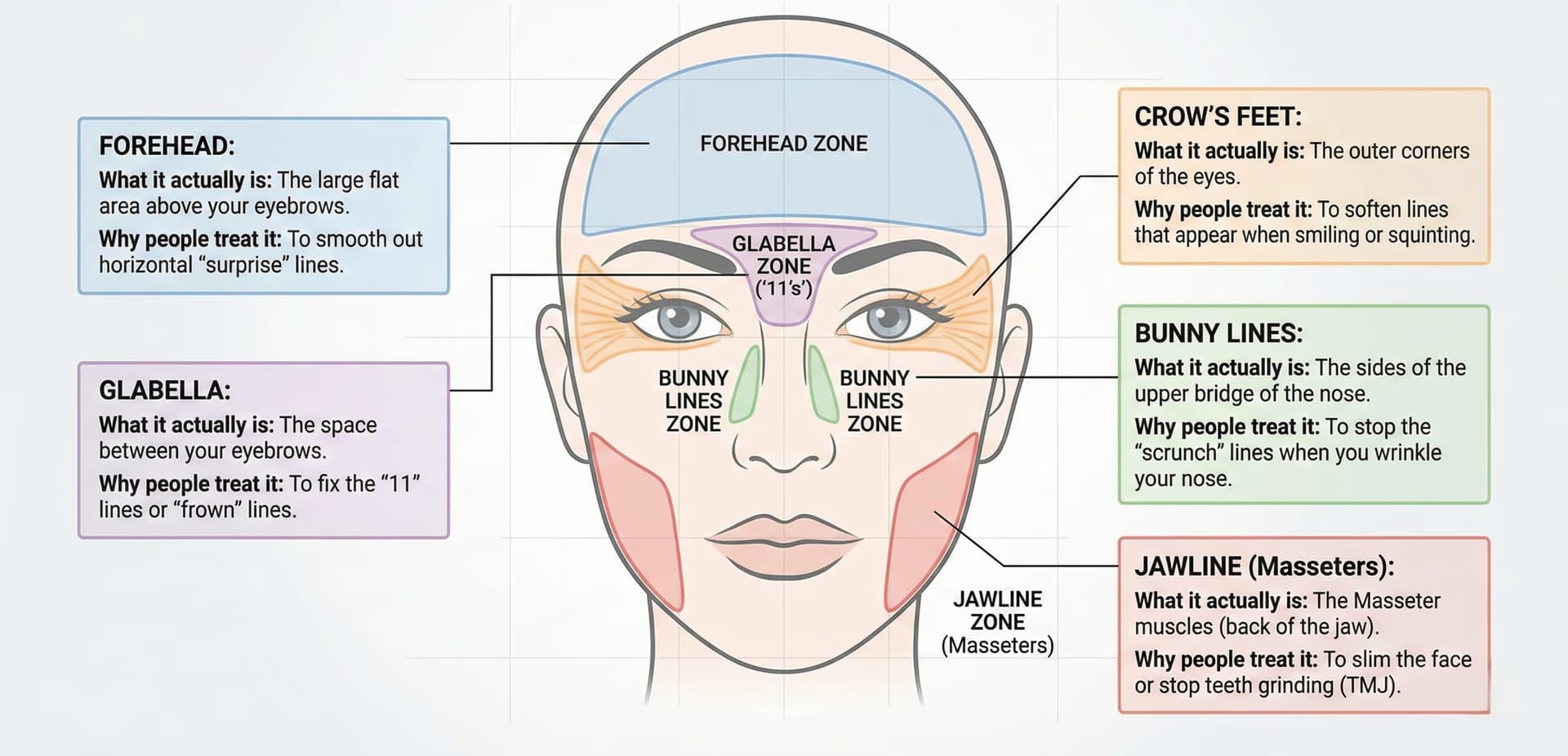 Botox injection zone map