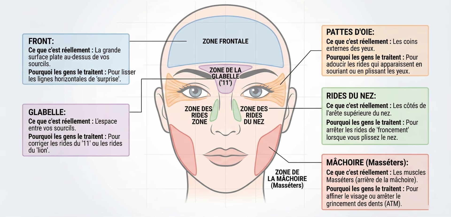 Carte des zones d'injection Botox