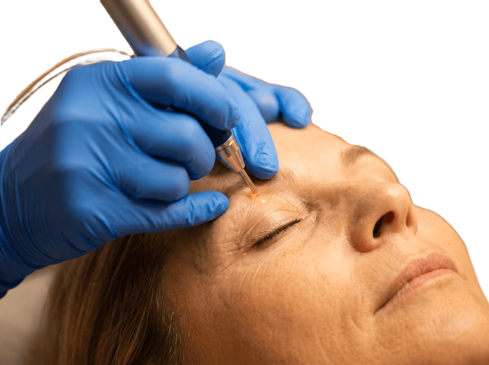 Blépharoplastie sans chirurgie